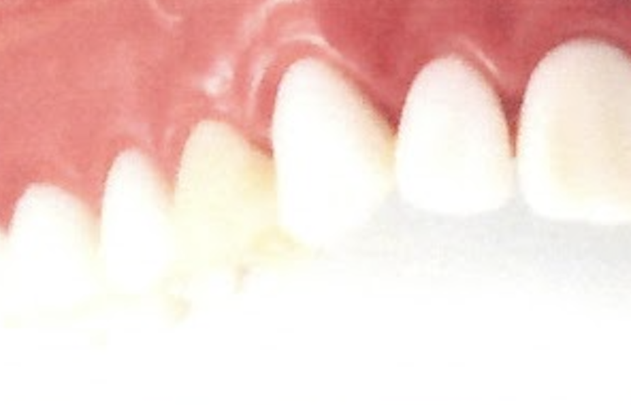 審美歯科の画像